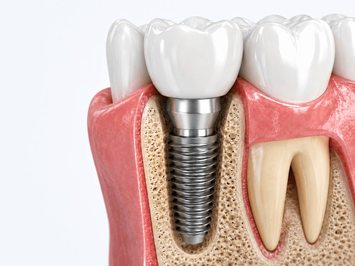 Dental Implants